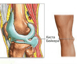 Киста Бейкера (Baker’s сyst)