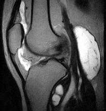 МРТ коленного сустава
