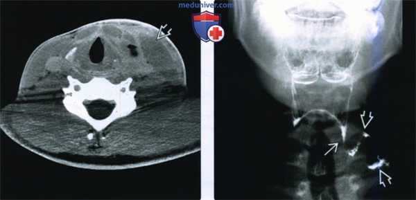КТ, МРТ при кисте четвертой жаберной щели