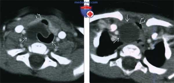 КТ, МРТ шейной кисты тимуса