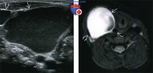 КТ, МРТ шейной кисты тимуса