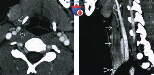 КТ, МРТ при кисте второй жаберной щели