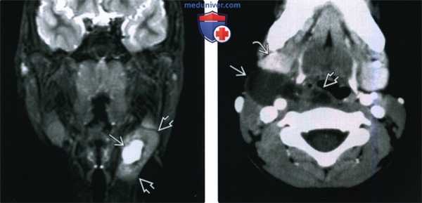 КТ, МРТ шейной кисты тимуса