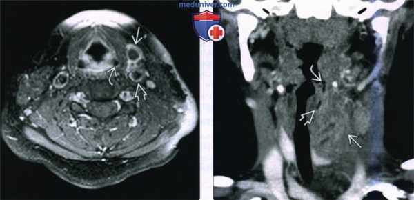 КТ, МРТ при кисте четвертой жаберной щели