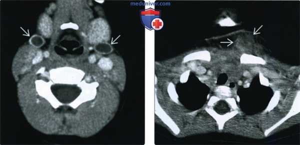 КТ, МРТ при кисте второй жаберной щели