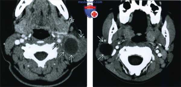 КТ, МРТ при кисте второй жаберной щели