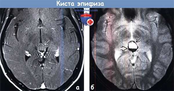 Киста эпифиза на КТ, МРТ