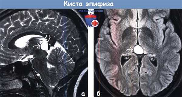 Киста эпифиза на КТ, МРТ