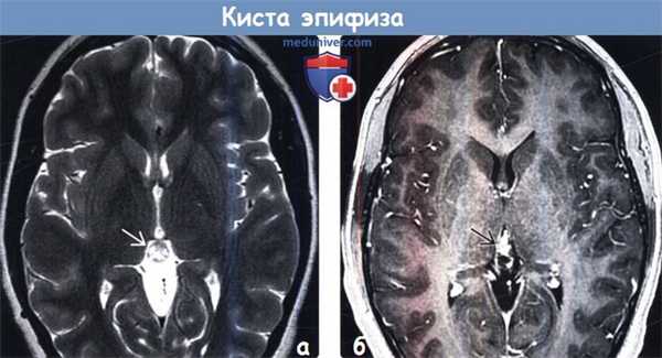 Киста эпифиза на КТ, МРТ