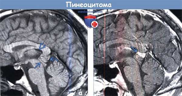 Пинеоцитома на МРТ