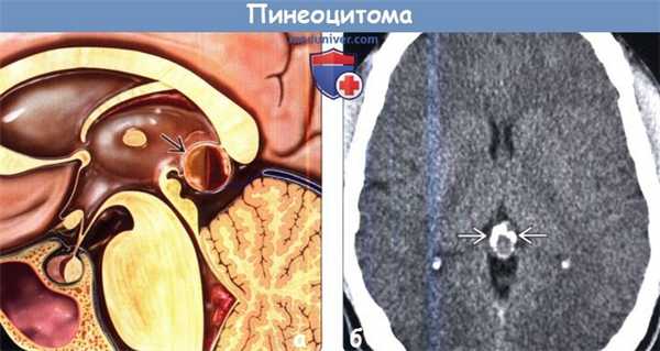 Пинеоцитома на КТ