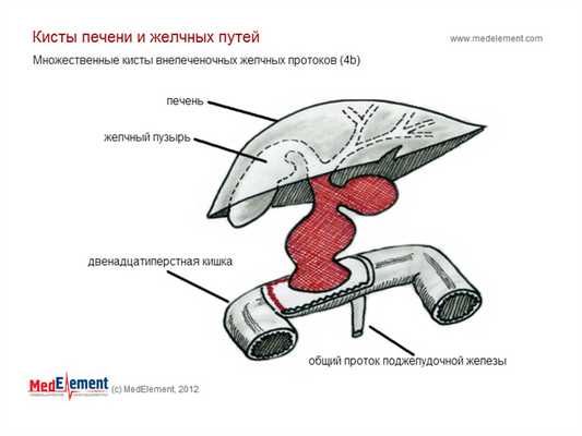 Множественные кисты внепеченочных желчных протоков
