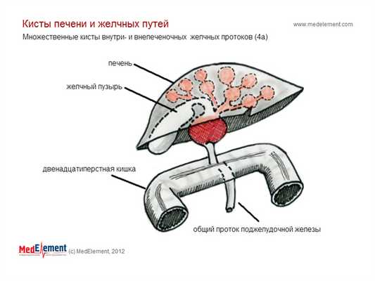 Множественные кисты внутри- и внепеченочных желчных протоков