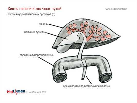 Кисты внутрипеченочных протоков