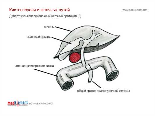 Дивертикулы внепеченочных желчных протоков