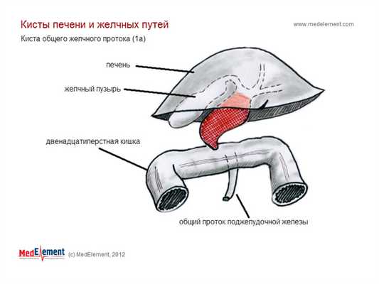 Киста общего желчного протока