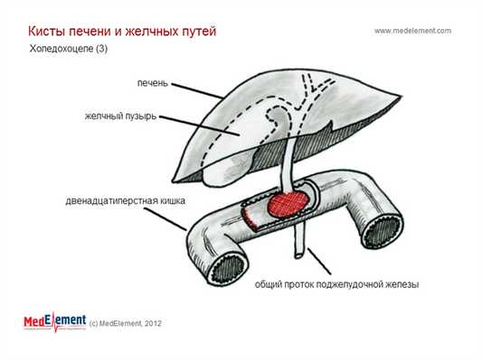Холедохоцеле
