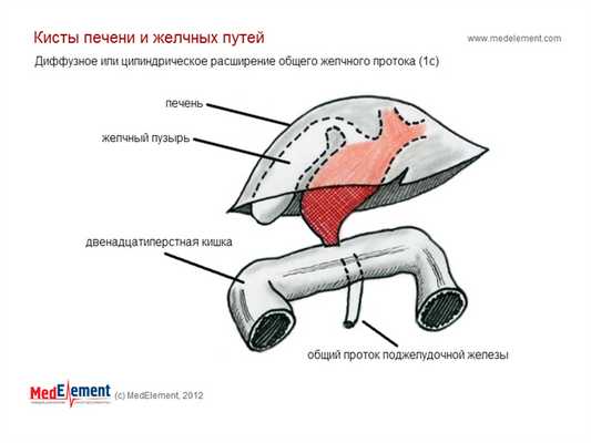 Диффузное или цилиндрическое расширение общего желчного протока