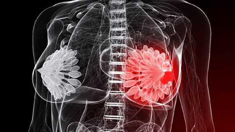 киста молочной железы