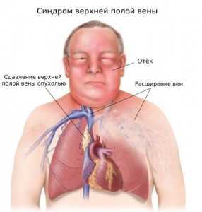 Кисты средостения