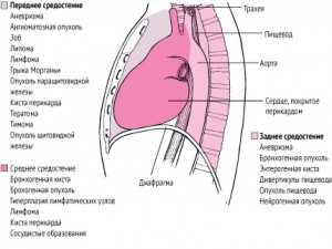 Техника проведения операций при образованиях средостения