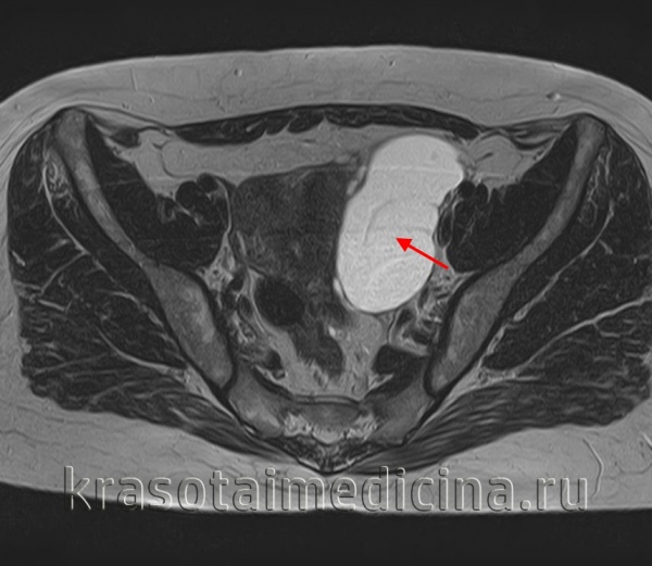 МРТ таза. Крупная кистома левого яичника.