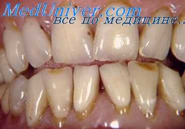 кламмерный протез