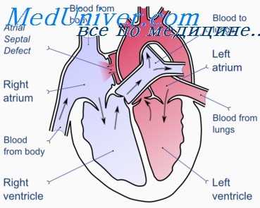 стеноз легочной артерии