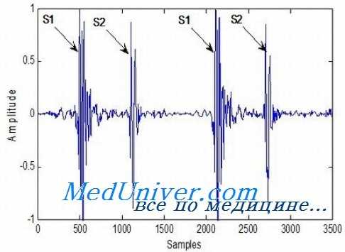 шумы сердца при триаде фалло