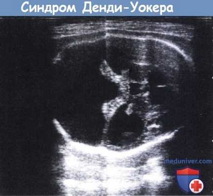 Мальформация Денди-Уокера