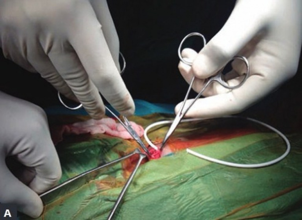 Аномалия Киари