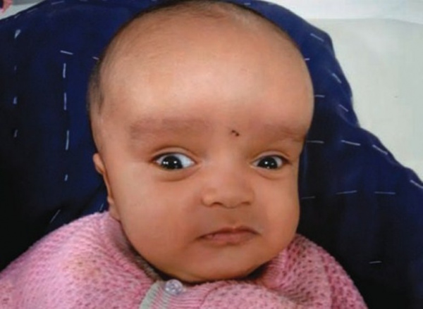 Синдром Денди-Уокера