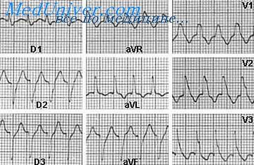 антиаритмические средства