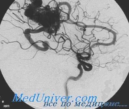 артерио-венозные мальформации