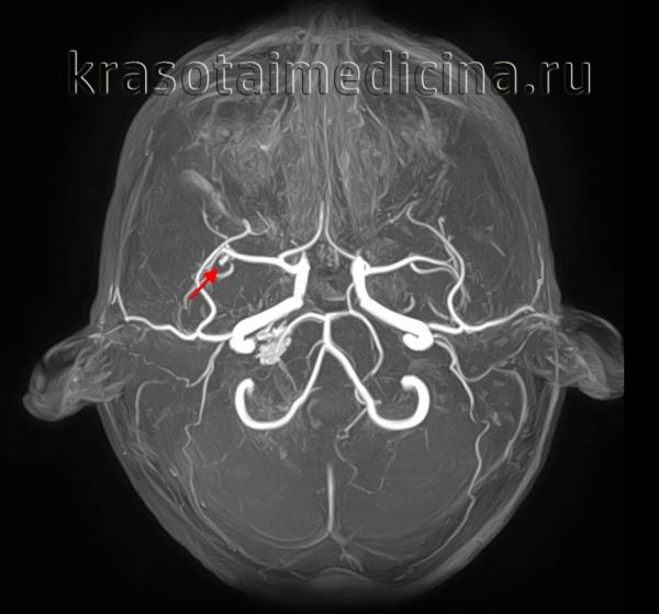 Артериовенозные мальформации спинного мозга