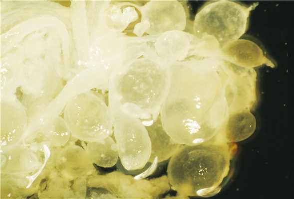 Факторы риска гестационной трофобластической неоплазии по ВОЗ