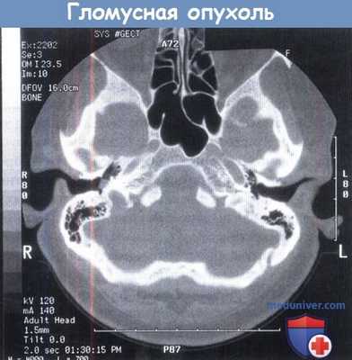 КТ при гломусной опухоли