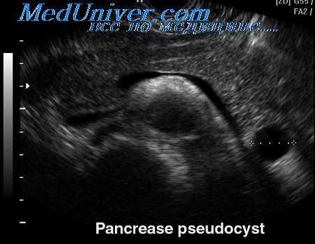 изменения селезенки