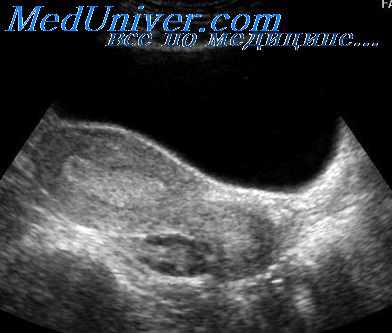 очаговые изменения селезенки