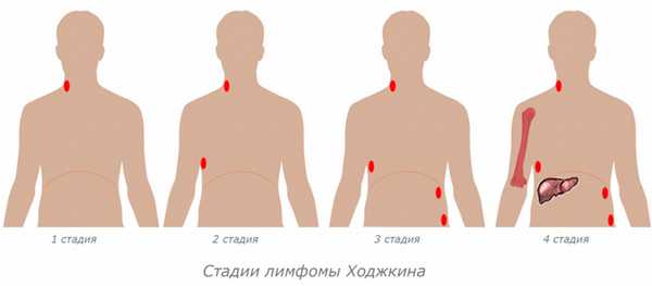 Лимфома Ходжкина.jpg