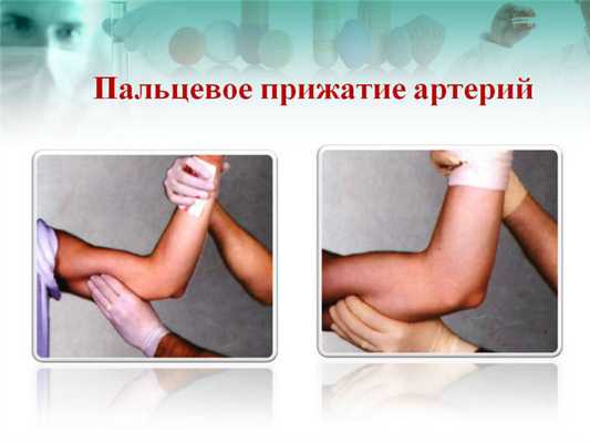 Пальцевое прижатие артерии
