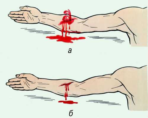 артериальное и венозное кровотечения