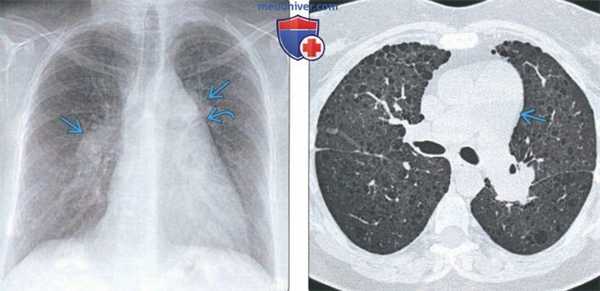 Легочная гипертензия на КТ легких