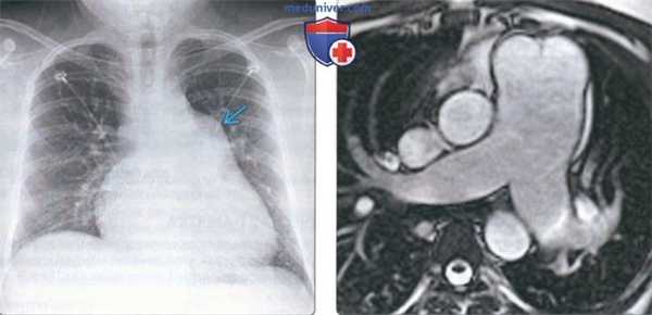 Легочная гипертензия на КТ легких