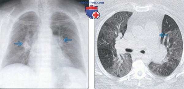 Легочная гипертензия на КТ легких