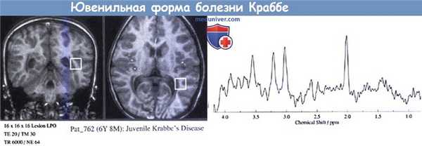Ювенильная форма болезни Краббе
