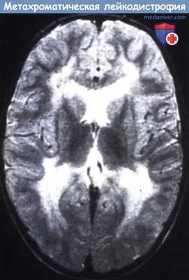 МРТ при метахроматической лейкодистрофии (MLD)