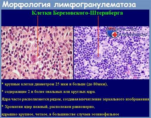 Морфология лимфогранулематоза