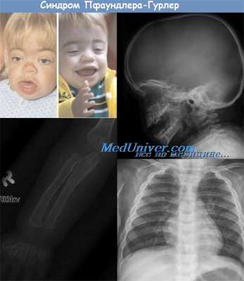 синдром Пфаундлера-Гурлер