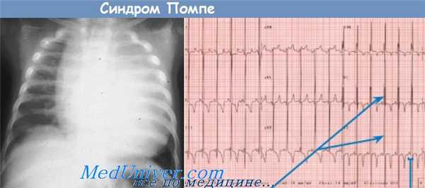синдром Помпе